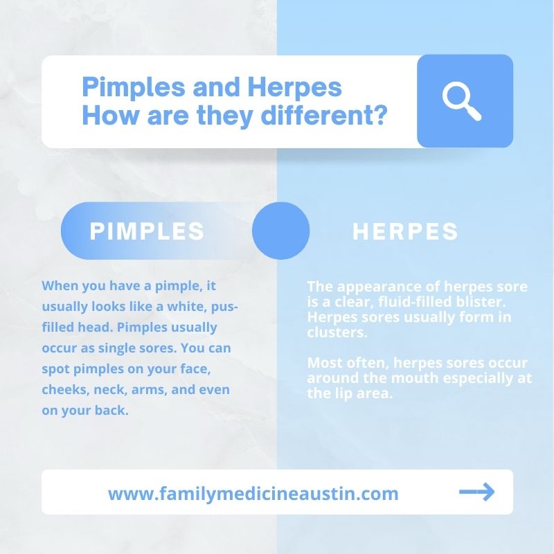 cold sore vs pimple