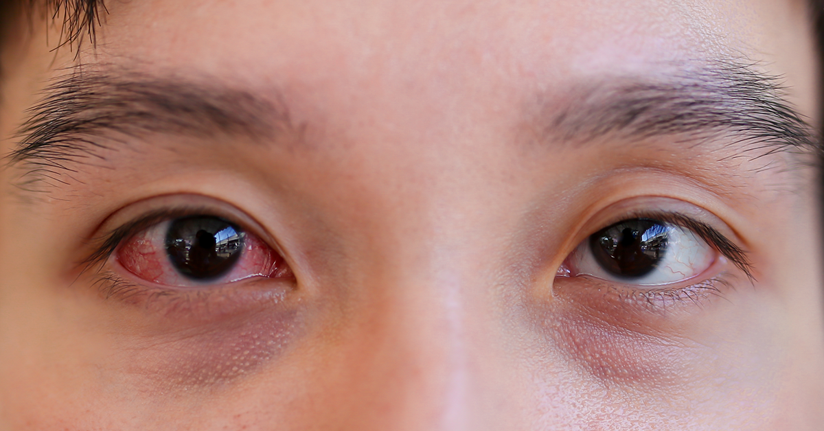 pink eye vs allergies