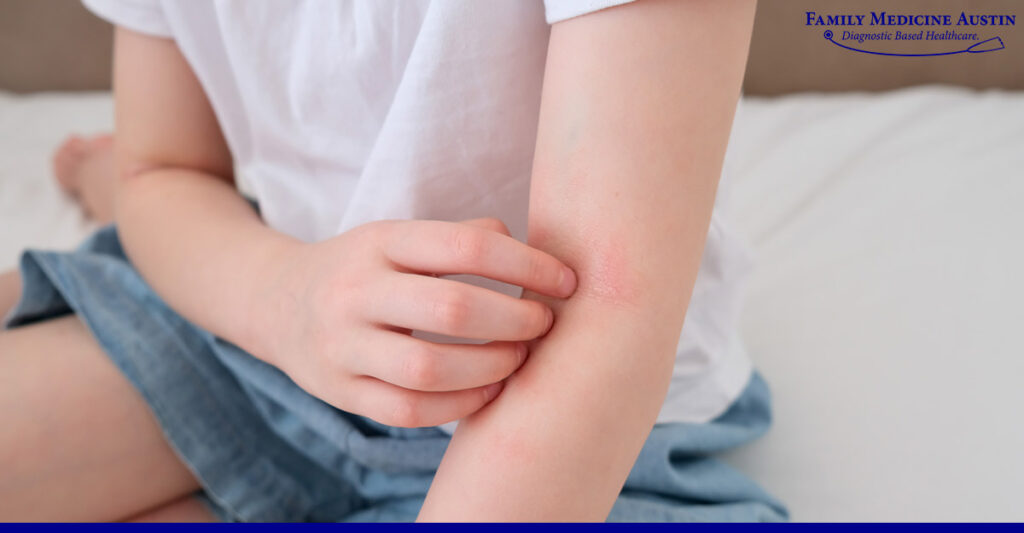 Autoimmune itching connective tissue diseases